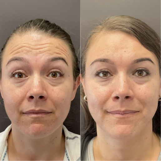 Botox Treatment