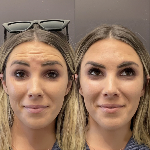 Botox Treatment