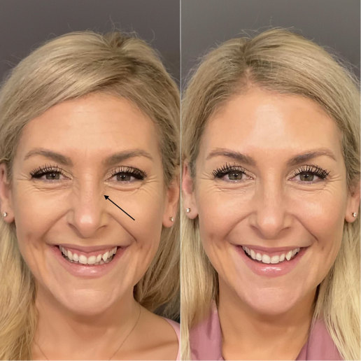 Botox Treatment