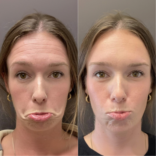 Botox Treatment
