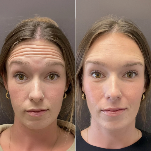 Botox Treatment