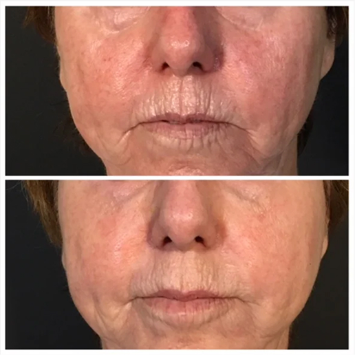 Facial Redness & Broken Capillaries