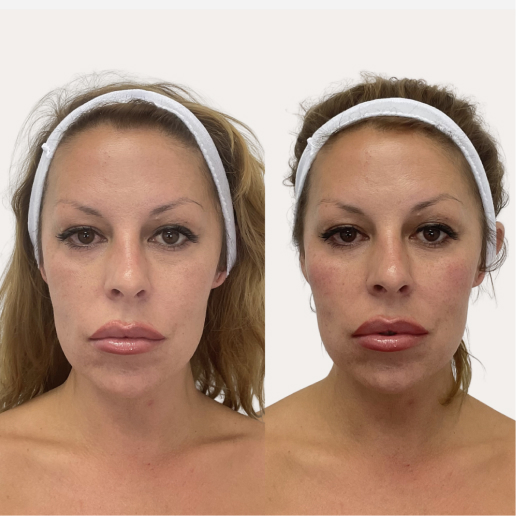 Facial Redness & Broken Capillaries