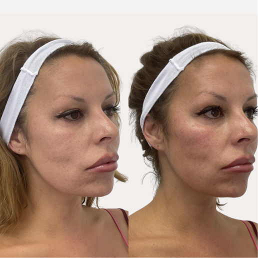 Facial Redness & Broken Capillaries