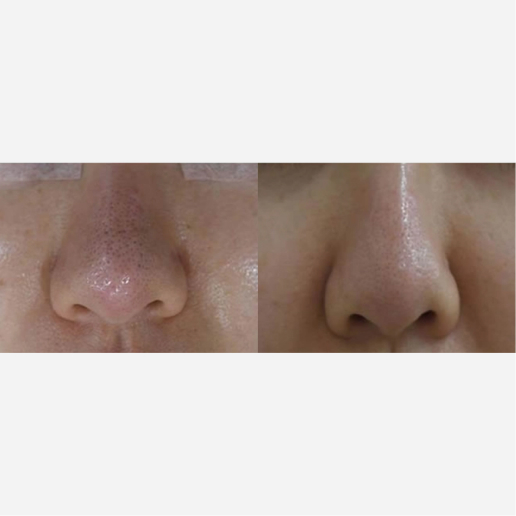 Carbon Laser Peel Treatment