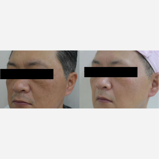 Carbon Laser Peel Treatment