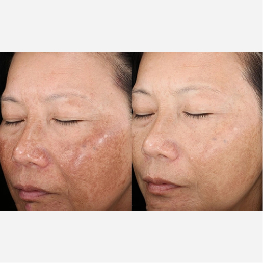 Chemical Peel Treatment