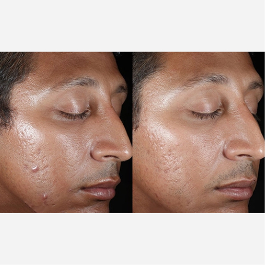 Chemical Peel Treatment