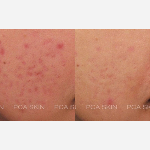 Chemical Peel Treatment