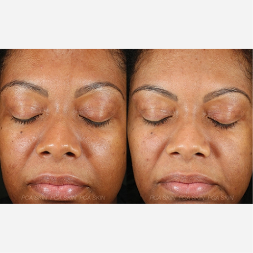 Chemical Peel Treatment