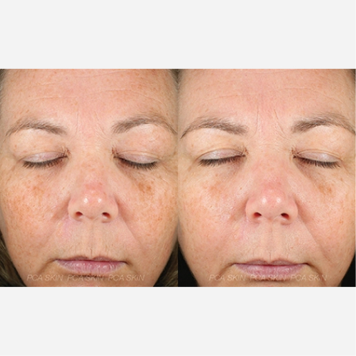 Chemical Peel Treatment