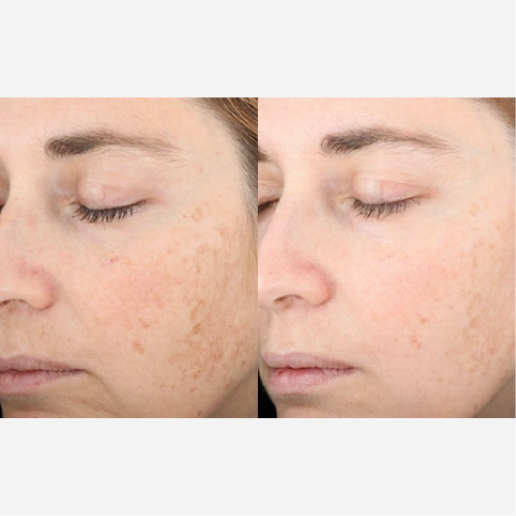 Chemical Peel Treatment