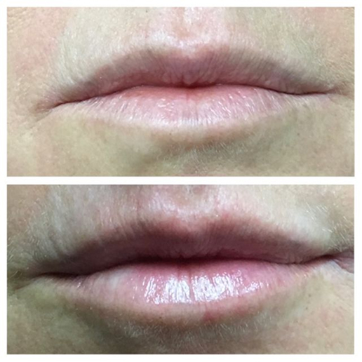 Dermal Fillers Treatment