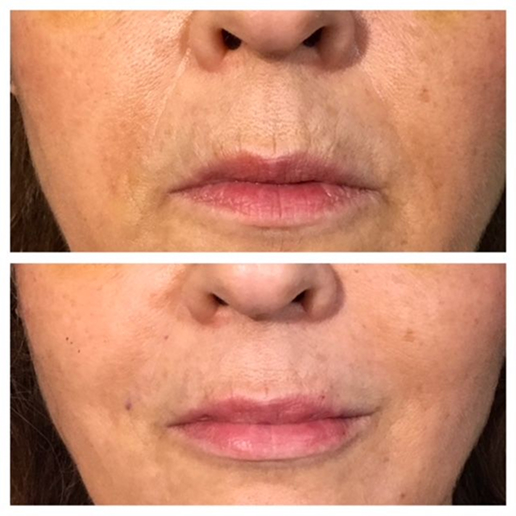 Dermal Fillers Treatment