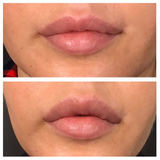 Dermal Fillers Treatment