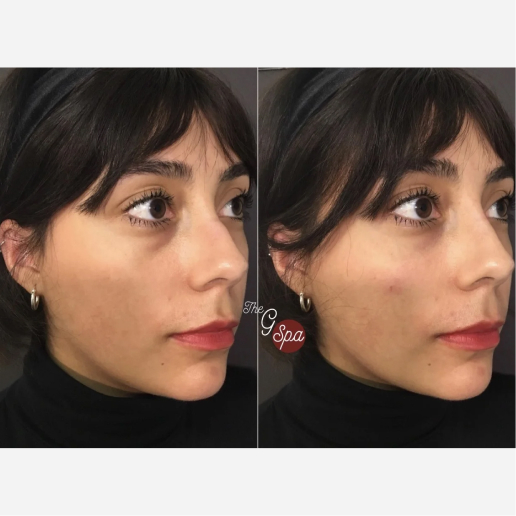 Dermal Fillers Treatment