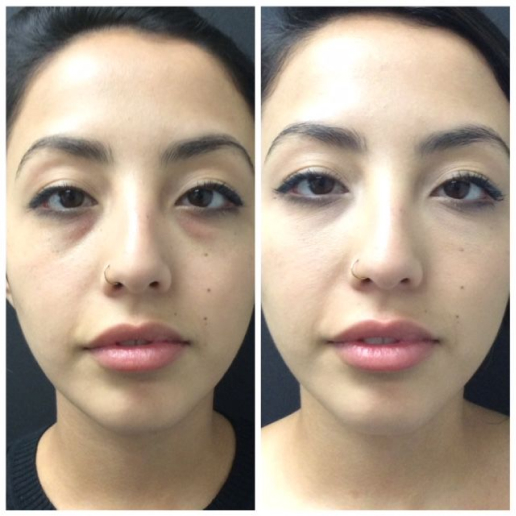 Dermal Fillers Treatment
