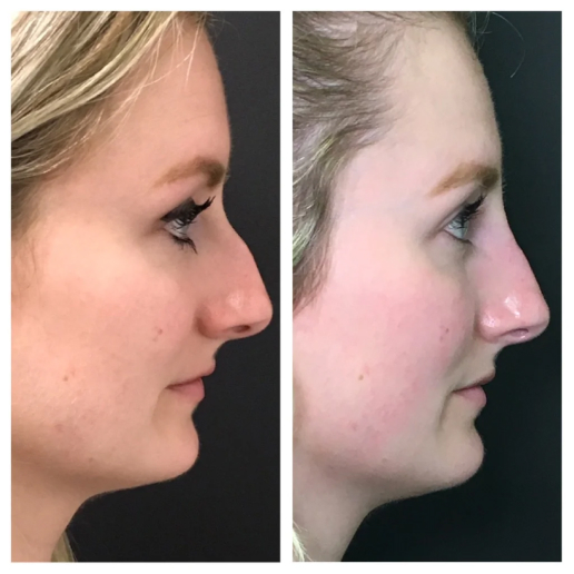 Dermal Fillers Treatment