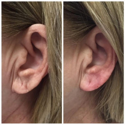 Dermal Fillers Treatment