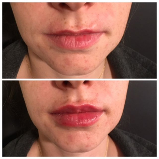Dermal Fillers Treatment