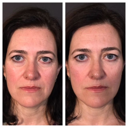 Dermal Fillers Treatment