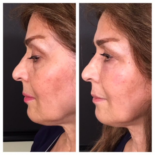 Dermal Fillers Treatment