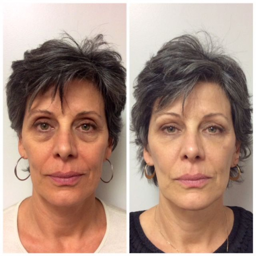 Dermal Fillers Treatment