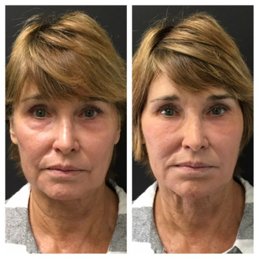 Dermal Fillers Treatment