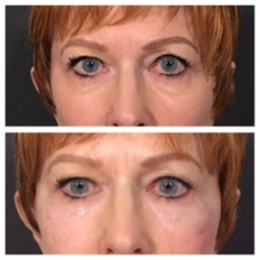 Dermal Fillers Treatment