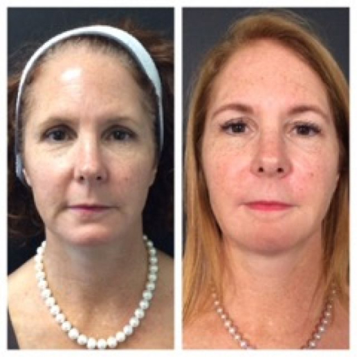 Dermal Fillers Treatment