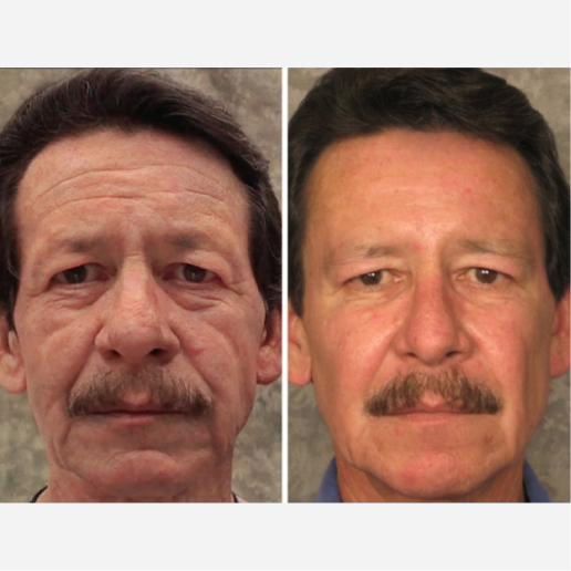 Dermal Fillers Treatment
