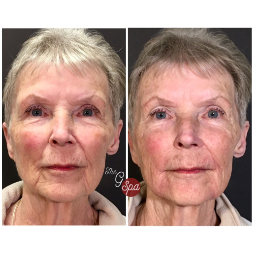 Dermal Fillers Treatment