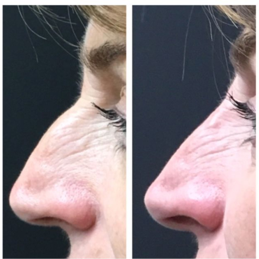 Dermal Fillers Treatment