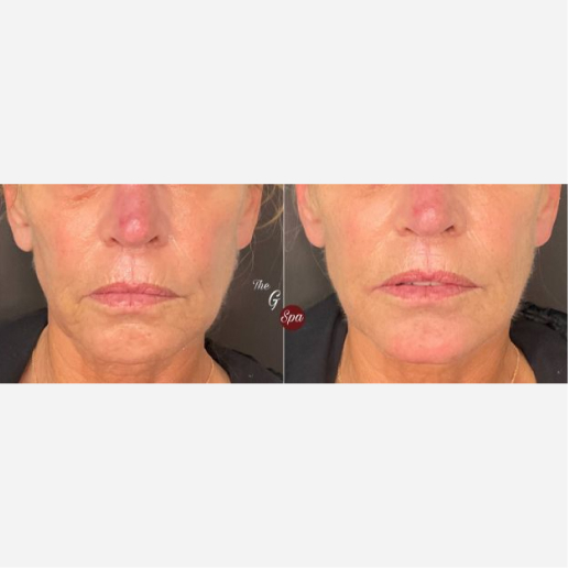 Dermal Fillers Treatment