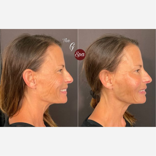 Dermal Fillers Treatment
