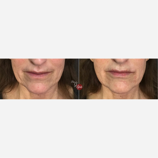 Dermal Fillers Treatment