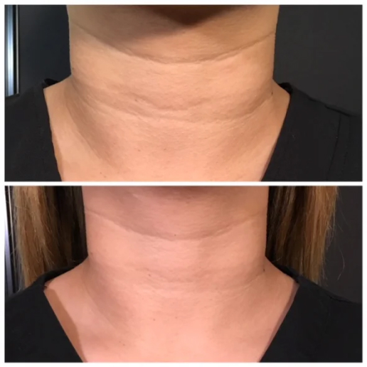 Dermal Fillers Treatment