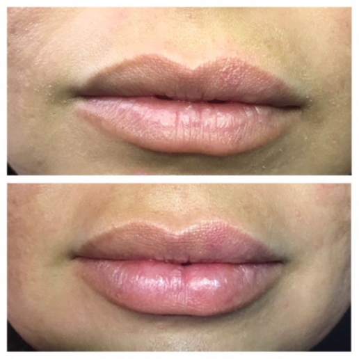 Dermal Fillers Treatment