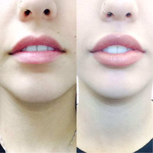 Dermal Fillers Treatment