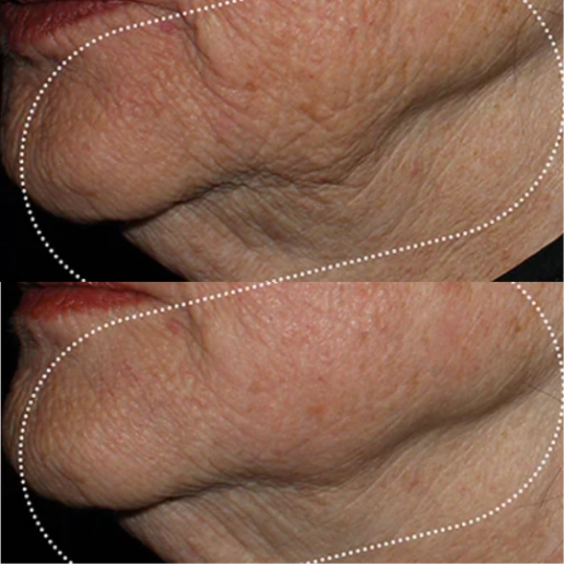 EMFACE Treatment