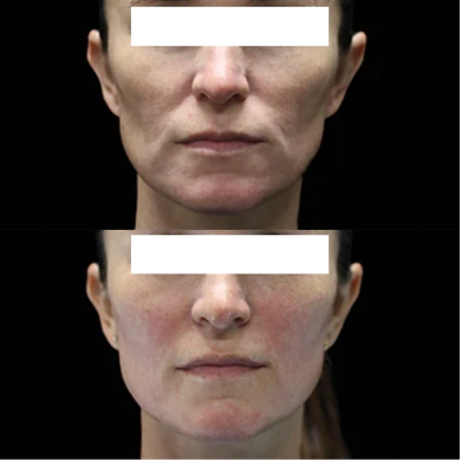 EMFACE Treatment