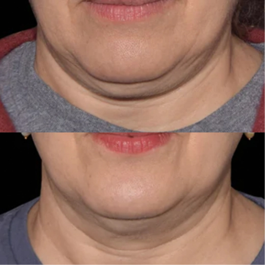 EMFACE Treatment