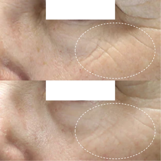 EMFACE Treatment