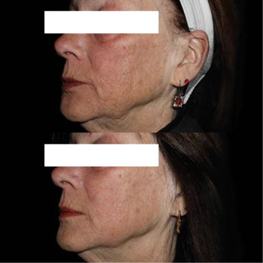 EMFACE Treatment
