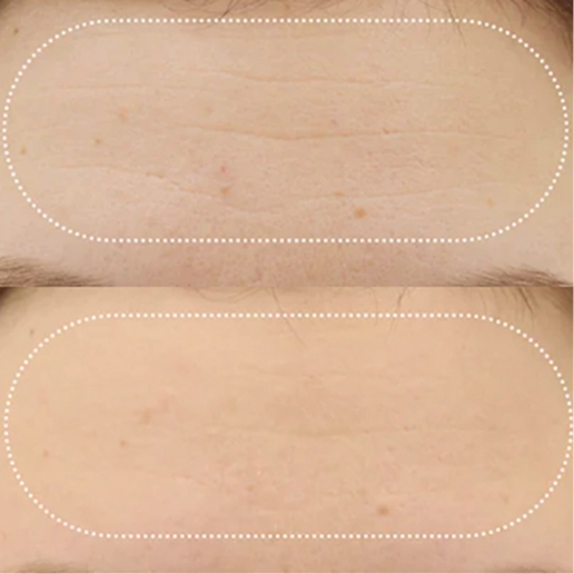 EMFACE Treatment