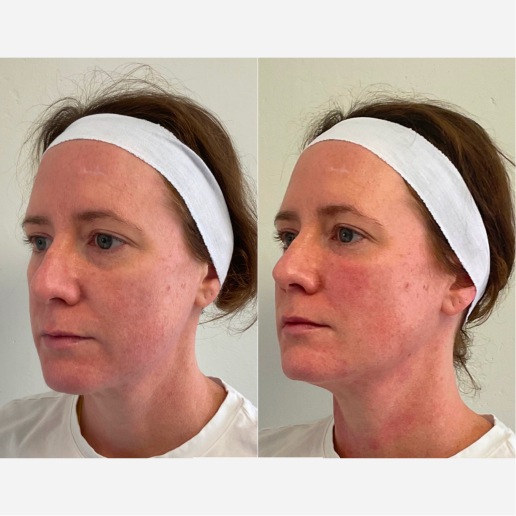 EZ Gel Treatment