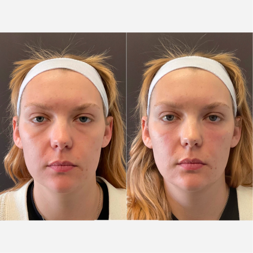 EZ Gel Treatment