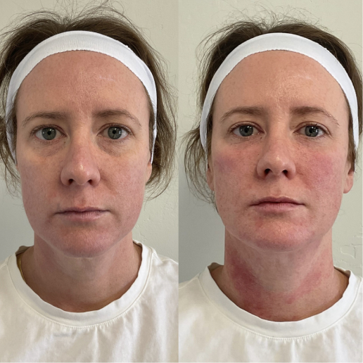 EZ Gel Treatment