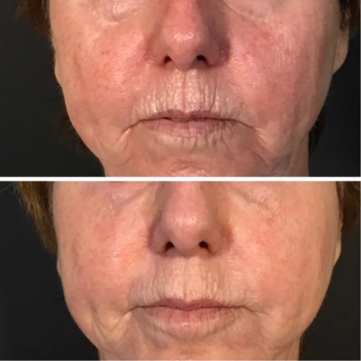 Elite Plus Treatment