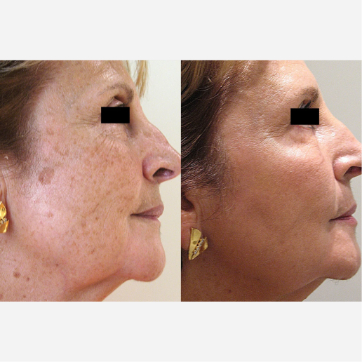 Elite Plus Treatment